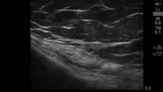 Ultrasound guided pes anserine bursitis injection [upl. by Tirrag]