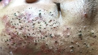 Blackhead Removal With Sac Dep Spa 100074091 [upl. by Abshier]