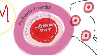 Erythema Multiforme with mnemonic  ALL you need to know [upl. by Stearn647]