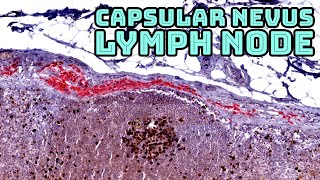 Benign Nevus in a Sentinel Lymph Node Capsular nevus with Ki67MART1 immunostain pathology [upl. by Anahpets]