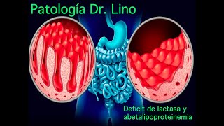 Anatomía patológica  Síndrome de Malabsorción  Deficiencia de lactasa y abetalipoproteinemia [upl. by Gennifer]