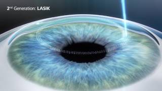 3rd Generation SMILE Laser Eye Surgery  Revolutionary bladeless procedure [upl. by Lyssa]