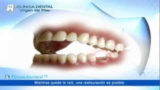 ¿Qué es la prótesis dental fija por Clínica Virgen del Pilar [upl. by Thanos]