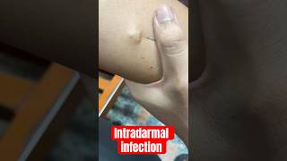 intradermal injection  intradermoterapia  subscribe medicalequipment cannula baby [upl. by Ahsimek]