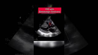 VSD with Eisenmenger Syndrome echocardiography echocardiogram echo shorts [upl. by Narol519]