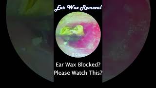 1020  Your Ear Wax Blocked earwaxremoval [upl. by Ydollem]