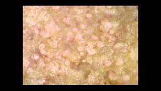 Scabies mites on skin crust [upl. by Kurzawa]