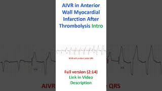 AIVR Accelerated Idioventricular Rhythm in Anterior Wall Myocardial Infarction After Thrombolysis [upl. by Ayk573]