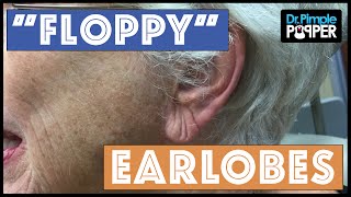 Taking 20 years off an Earlobe Earlobe Thinning with Dr Pimple Popper [upl. by Odrick]