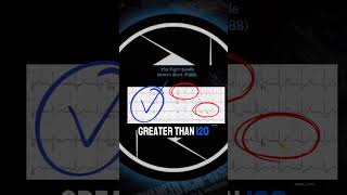 Identifying the Right Bundle Branch Block [upl. by Atews]