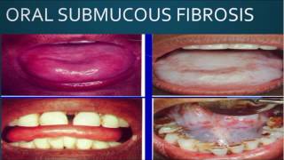 Oral Submucous Fibrosis OSMF  Premalignant Lesion I Dental Guide I Dr Bimal Chand I [upl. by Arabrab]