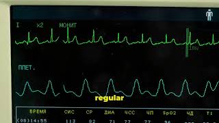 Spot 21 Atrial Flutter FAST shorts healthcare [upl. by Nylcaj]