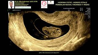 Hygroma Kistik  Hydrops Fetalis  NT Tebal 11 weeks [upl. by Yaf]