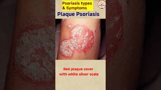 Psoriasis ke lakshan  type of psoriasis shortfeed2024 [upl. by Kean]