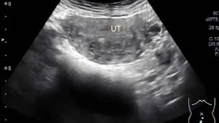 Uterine fibroids [upl. by Nnaasil226]