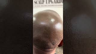 SCALP MICROPIGMENTATION in SRILANKA [upl. by Marola]