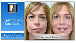 My personal experience of upper and lower blepharoplasty with Dr Julian De Silva [upl. by Ynor498]