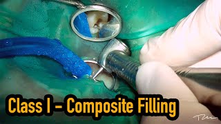 Tooth colored filling  Class I composite restoration [upl. by Shapiro608]