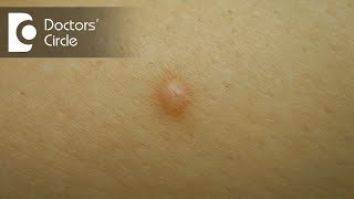 Diagnosis of skin colored lump with brown spot  Dr Nanda Rajaneesh [upl. by Kristin601]