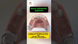 Nance Orthodontic Appliance  Braces  Orthodontics [upl. by Xad]