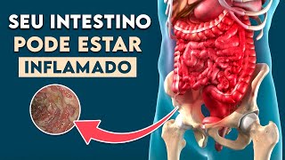 INTESTINO INFLAMADO Sintomas de Doença Inflamatória Intestinal │ Doença de Crohn [upl. by Iderf]