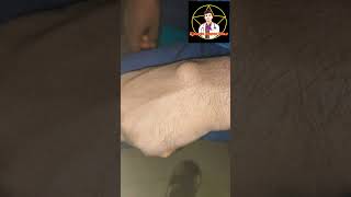 wrist ganglion cyst removal [upl. by Adieno]