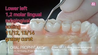 Lower left 12 molar lingual subgingival scaling 1112 1314 gracey curet [upl. by Rekcut]