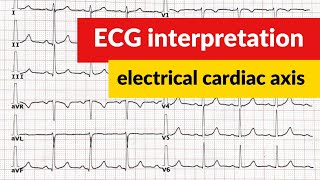 Electrical cardiac axis ECG interpretation [upl. by Kiker275]