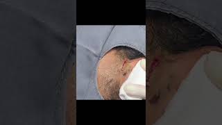 An Ear Cyst You Dont Want to Miss [upl. by Vaas89]