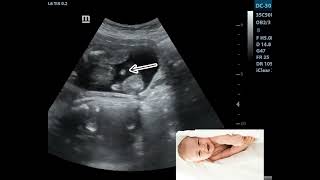 Ultrasound Showing Baby Boy in breech Presentation [upl. by Aiuqcaj341]