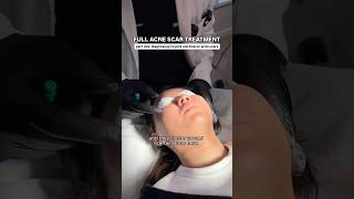 FULL Acne Scar Treatment for Ice Pick  Boxcar Scars with Dr Qazi  Part One Diagnosing the Scars [upl. by Arenahs]