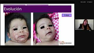 DERMATOLOGIA PARA PEDIATRAS  Dermatitis Atopica y Diagnosticos diferenciales en practica diaria [upl. by Brinna689]