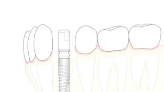 ANKYLOSImplantation – chirurgische und prothetische Vorgehensweise [upl. by Niliac685]