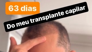 2 mês do meu transplante capilar Se liga na evolução cabelo transplantecapilar fue [upl. by Schofield668]