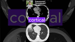 PNEUMONIA or pulmonary THROMBOSIS  CT SCANS Ep 8 medicalimaging ctscan pneumonia thrombosis [upl. by Savanna]