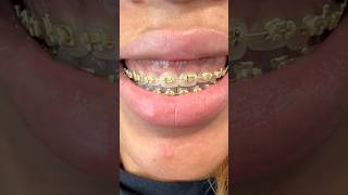 Gold braces ✨ braces [upl. by Xaviera]