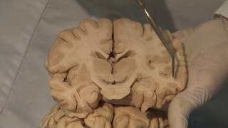 Cortical Localization Neuroanatomy Video Lab  Brain Dissections [upl. by Ettenaj]