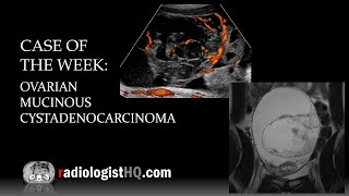 Case of the Week Ovarian Mucinous Cystadenocarcinoma Ultrasound amp MRI [upl. by Anoniw]