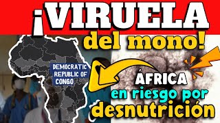 ALERTA⚠️ CIENTÍFICOS ALERTAN QUE DESNUTRICIÓN COMPLICARÍA CASOS DE VIRUELA EN ÁFRICA [upl. by Tabber]