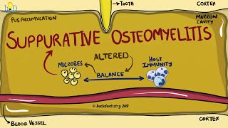 Suppurative Osteomyelitis of the jaw [upl. by Ylrebmit707]