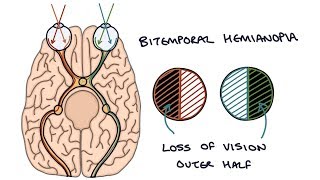 Understanding Bitemporal Hemianopia [upl. by Niledam]