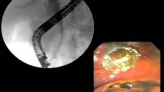 WallFlex® Biliary Metal Stent animation with clinical footage [upl. by Lexis]