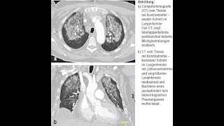 Daptomycin assoziierte eosinophile Pneumonitis [upl. by Robinet430]