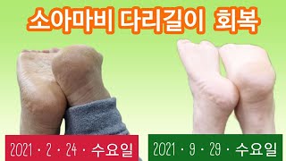 소아마비재활운동다리길이차이 소아마비다리 길이 차이가 회복 되었어요 [upl. by Cadman]