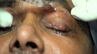 Botulinum Toxin Injection for Blepharospasm and Hemifacial Spasm Drs Vidushi Suresh Pandey SuVi Eye [upl. by Acinomal]