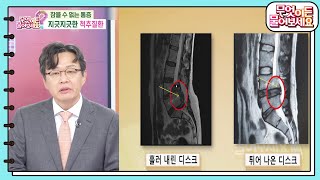 닥터의 경고 심한 방사통 추간판 탈출증디스크 의심하라 무엇이든 물어보세요  KBS 241104 방송 [upl. by Elletnahc]