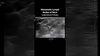 Neck Lymph Nodes ultrasound imaging cancerawareness cases [upl. by Nashbar]