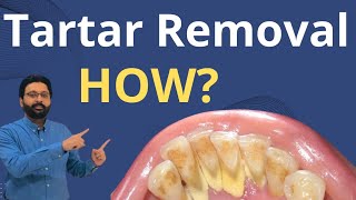 Tartar Removal from Teeth  Dental Teeth Cleaning [upl. by Yecram787]