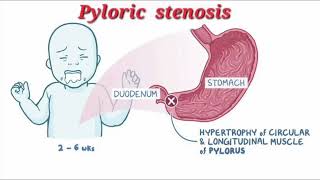 Pyloric stenosis mrcpch Video station [upl. by Amees]