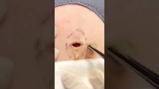 Dr Pimple Popper vs A Surprise Opening shorts [upl. by Lewanna333]